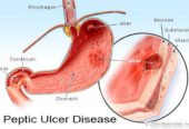 Ulcers Solution Product