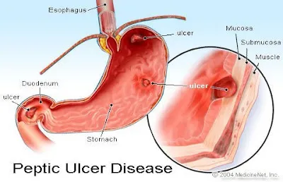 Ulcers Solution Product